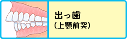 出っ歯（上顎前突）
