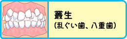 叢生（乱ぐい歯、八重歯）