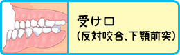 受け口（反対咬合、下顎前突）